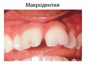 Afwijkingen in de grootte en vorm van de microdentiteit van de tanden en microdentiteit