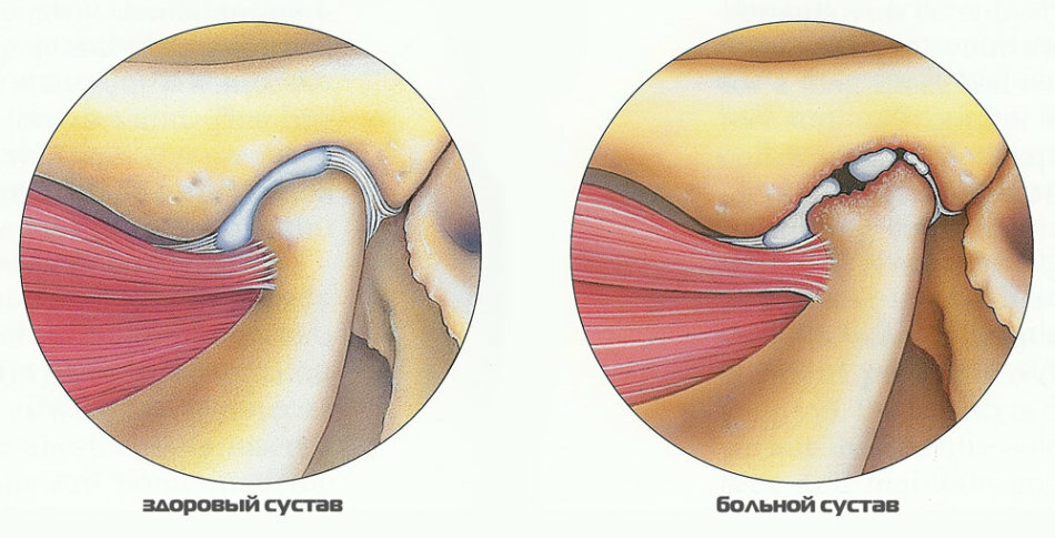 Proč lícní kloub a čelist ubližují u ucha nalevo a napravo, je bolest žvýkat: důvody, léčba.Čelisti kliknou na jednu stranu a klouby čelistí a lícní kůže se při otevření ústy bojí: co mám dělat, kterému lékaři mám kontaktovat? Osteoartróza čelisti: příznaky, léčba