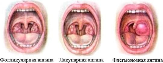 phlegmonous sore throat