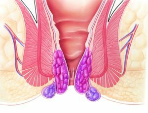 Bruk av Aurobin til behandling av hemorroider og andre proktologiske sykdommer