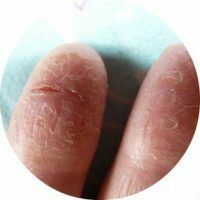 Kaj storiti, če koža razpade na prste