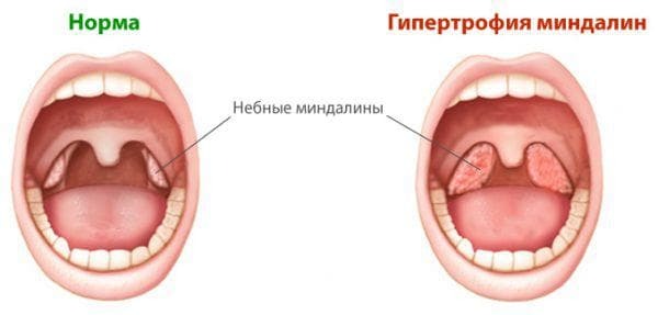 How to treat a white coating on tonsils without temperature