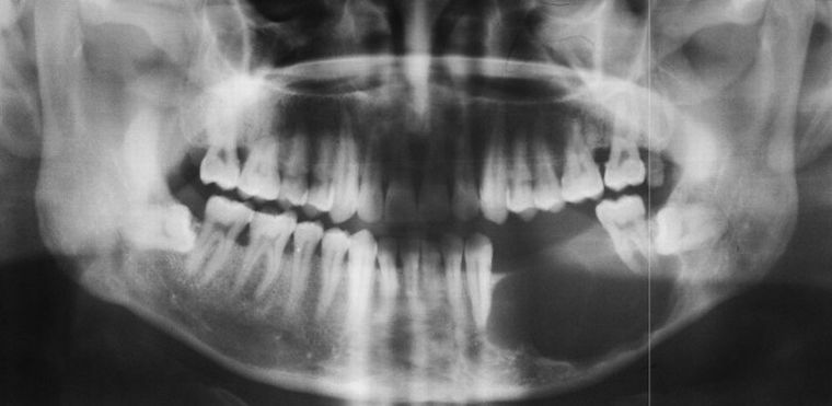 Ameloblastom ist ein Kiefer-Tumor aus den Zellen des Zahn Rudiment gebildet