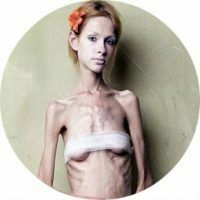 Anorexian syyt ja hoito