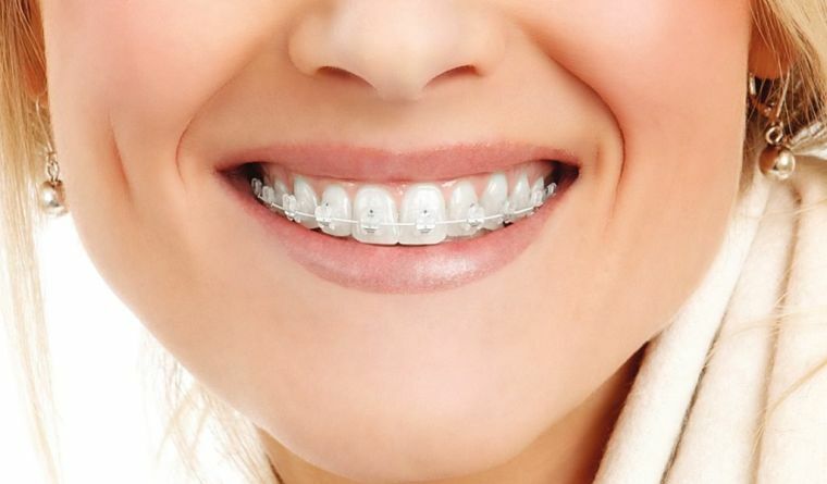 What are the white braces and what is the reason for their popularity?