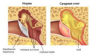 pain in the ears with otitis