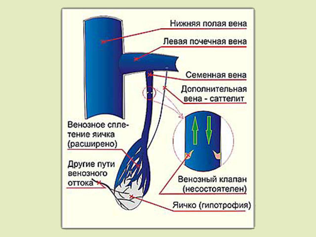 Операция Варикоз Машонки