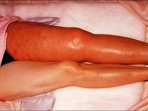 Tromboflebite acuta superficiale - trattamento e conseguenze pericolose dell'infiammazione delle vene superficiali