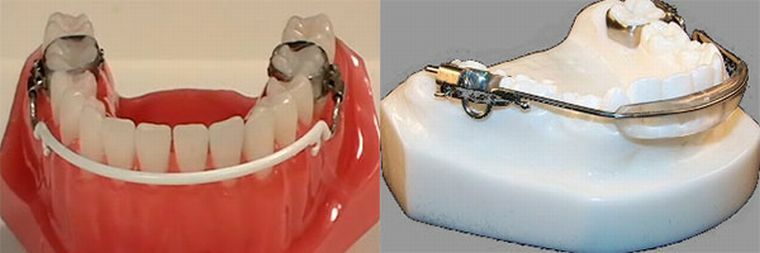 Obiettivi e caratteristiche dell'applicazione dei paracolpi in ortodonzia