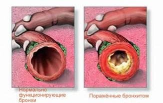 treatment of obstructive bronchitis