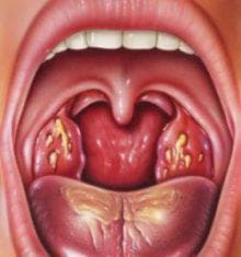 stomatitis on tonsils