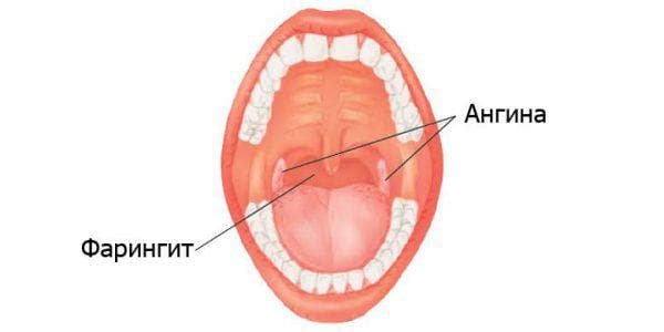 fungal tonsillitis and pharyngitis
