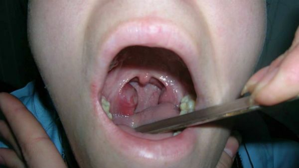 Mononucleosis in children - what is this disease, its causes, symptoms and treatment