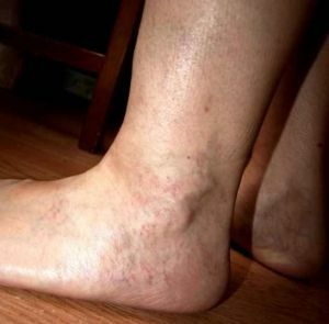 Treatment of thrombophlebitis with folk remedies: recipes, advice and feedback from patients
