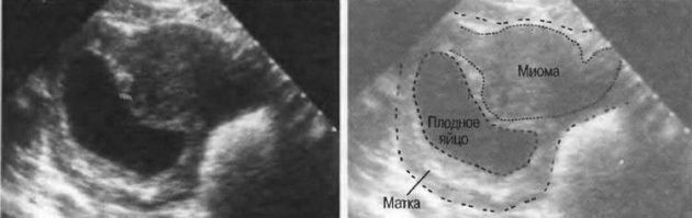 Uterusmyome in der Schwangerschaft: Im Frühstadium, im zweiten und dritten Trimester, die Folgen