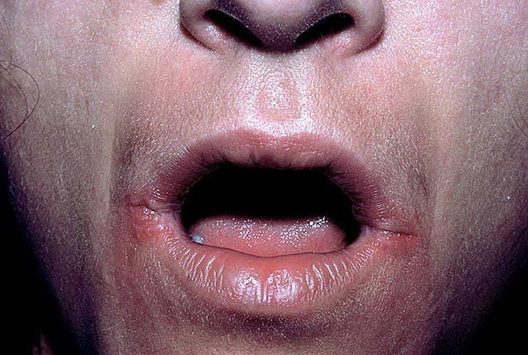 Chéilite angulaire: les causes, les symptômes et le traitement des collations de candidose dans les coins de la bouche