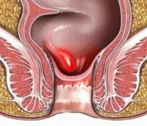 Removal of hemorrhoids