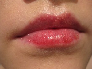 Spots på läpparna - förstå orsakerna