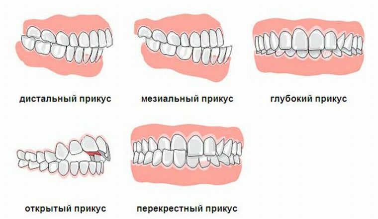 Profilaxis y corrección de la mordedura y ubicación de los dientes en los niños