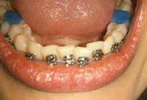Kann ich Zahnspangen auf Kronen, Zahnersatz, Implantate und Dichtungen setzen?