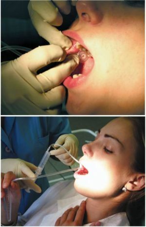 Sialografiya - procedimento para o diagnóstico de doenças das glândulas salivares