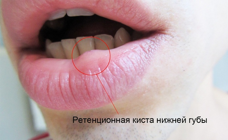 Retention cyst on the lip: a hidden danger inside you