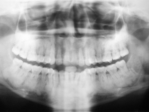 Cementoma - audzējs, kas attīstās zobu sakņu zonā