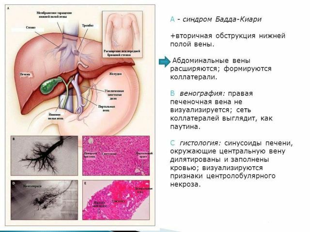 Trombóza žilní žíly nebo Badda-Chiariho syndrom