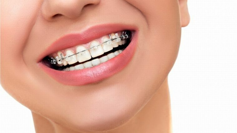 Actually, braces - when to put, what to eat, whether it is possible to smoke and other acute issues