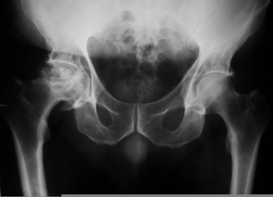 What to do with pains in the hip joint when walking, getting up and sitting, at night? How to treat pain in the hip joint in women and men with drugs and folk remedies?