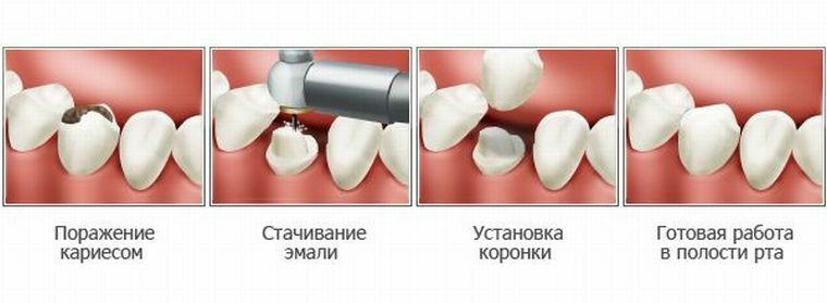 Applicazione di ceramiche non metalliche in odontoiatria