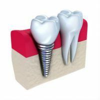 Wat zijn de contra-indicaties voor implantatie van een tandarts?