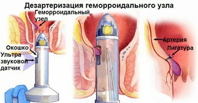 The course of deserterization of hemorrhoids