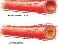 ateroskleroza