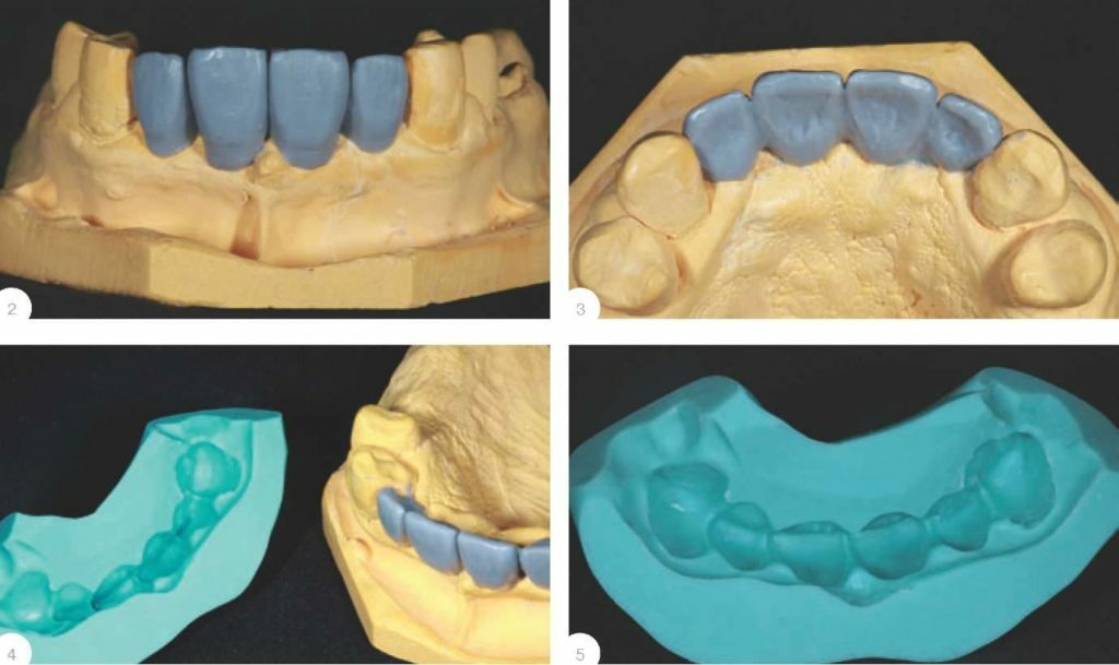 Fitur metode kunci silikon dalam kedokteran gigi