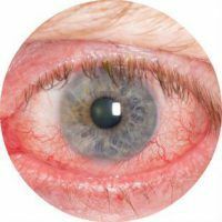 Príčiny a liečba červených očí u detí a dospelých