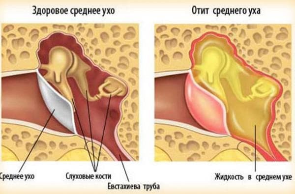 דלקת של הסימפטומים של האוזן התיכונה