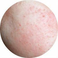 Hvad er keratose i huden og hvordan man behandler det?