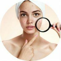 What helps to get rid of pimples and their marks on the skin
