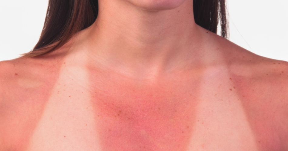 Sunburn skin: symptoms, first aid, treatment. What to do after a sun burn?
