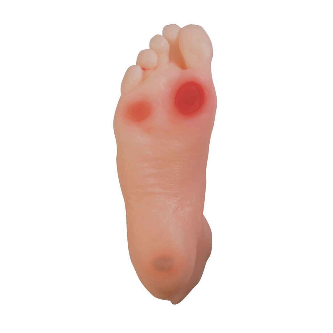 Hur blir man av med callus på dina fötter? Vilka typer av korv finns det?