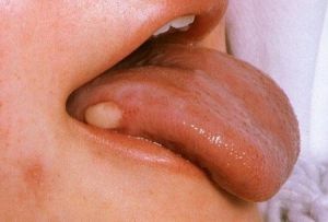 Bolhas na língua: possíveis causas e métodos de tratamento