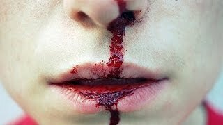 Bagaimana cara menghentikan darah dari hidung?