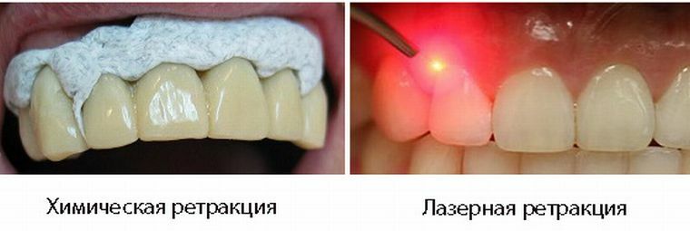 Gingivale retractie is een onplezierige maar noodzakelijke tandheelkundige procedure