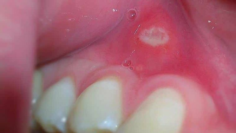 Stomatitis, manifestiert sich am Zahnfleisch und am Himmel - ein eher seltener, aber unangenehmer "Gast"