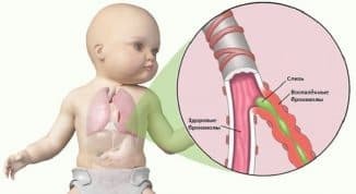 acute tracheitis treatment in a child