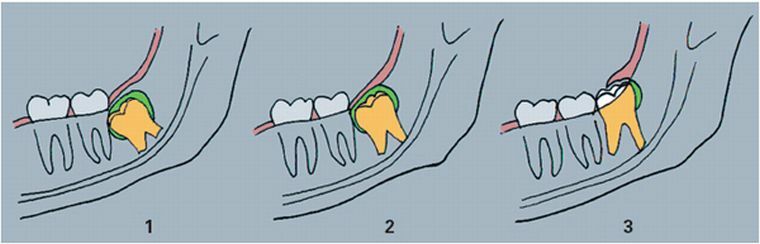 שיניים גמורות ודיסטופיות: הסרה וטיפול