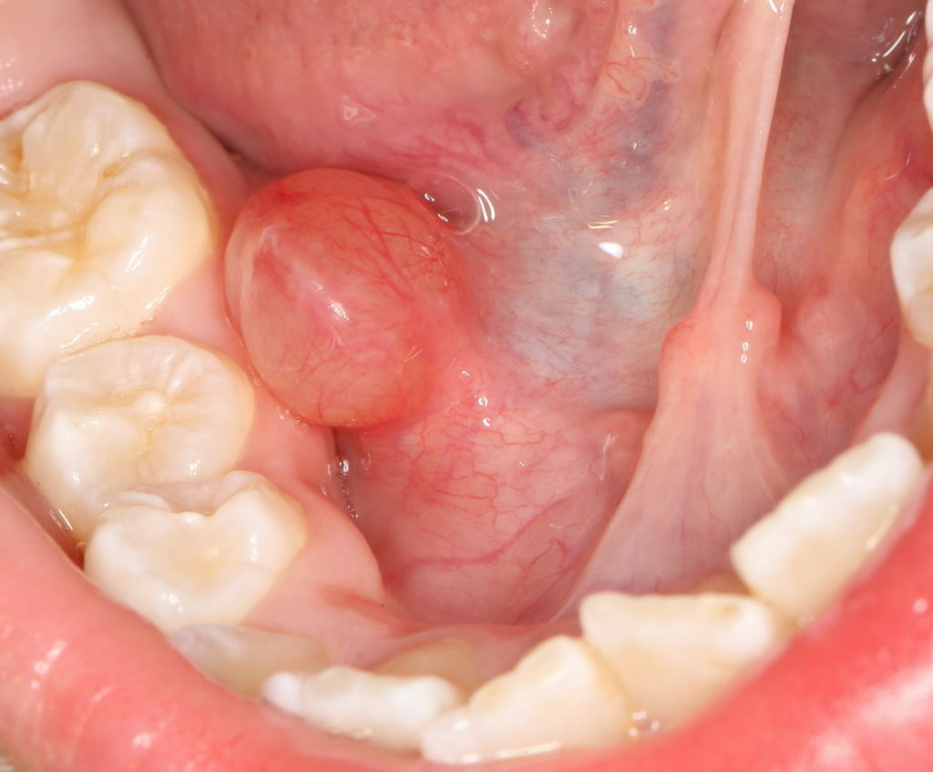 De redenen voor de vorming van de bal onder de tong en de behandelingsmethoden