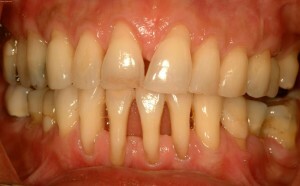 Zapalenie jamy ustnej w języku: przyczyny i leczenie choroby u dorosłych pacjentów