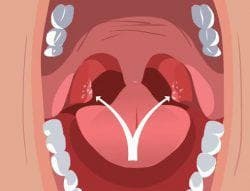 purulent plugs in tonsils